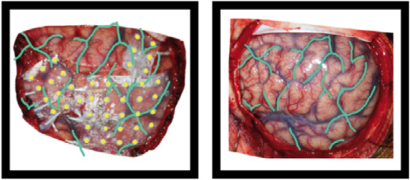 operative photo of ECoG electrodes
